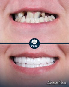 before-after photo zirconia-crown-installation