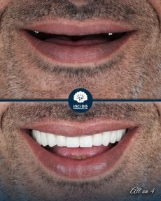 before-after photo all-on-4-dental-implants