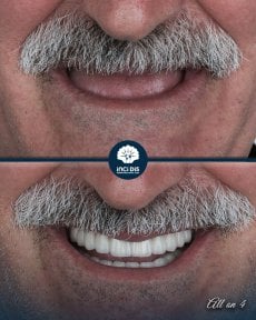 before-after photo all-on-4-dental-implants