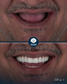 before-after photo all-on-4-dental-implants