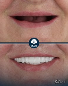 before-after photo all-on-4-dental-implants