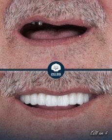 before-after photo all-on-4-dental-implants