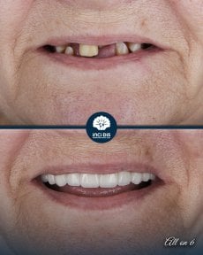before-after photo all-on-6-dental-implants