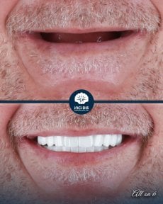 before-after photo all-on-6-dental-implants
