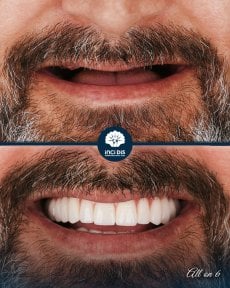 before-after photo all-on-6-dental-implants
