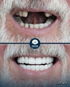 before-after photo all-on-6-dental-implants
