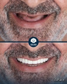 before-after photo all-on-6-dental-implants