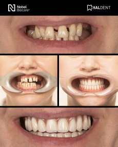 before-after photo installation-of-a-veneer