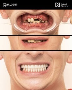 before-after photo installation-of-a-veneer