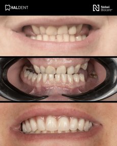 before-after photo installation-of-a-veneer