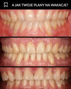 before-after photo installation-of-a-veneer