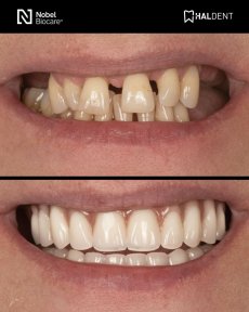before-after photo installation-of-a-veneer