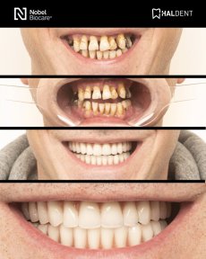 before-after photo installation-of-a-veneer