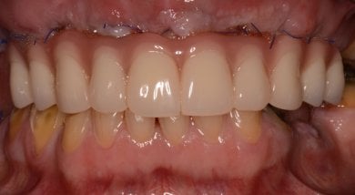 before-after photo installation-of-a-veneer