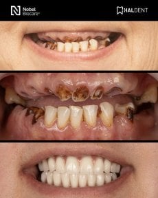 before-after photo installation-of-a-veneer