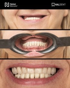 before-after photo installation-of-a-veneer