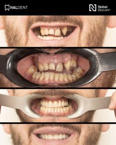 before-after photo installation-of-a-veneer