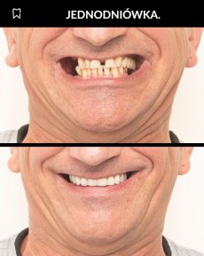 before-after photo installation-of-a-veneer