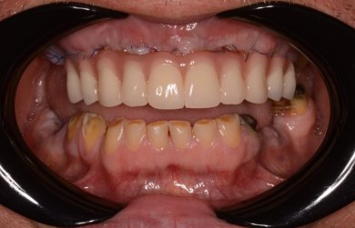 before-after photo installation-of-a-veneer