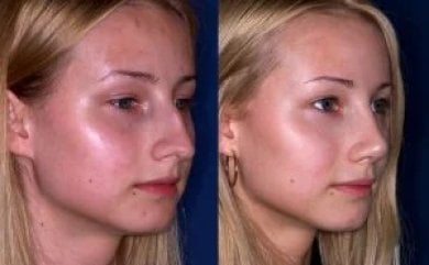before-after photo rhinoplasty-nose-job