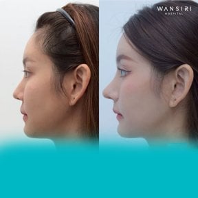 before-after photo rhinoplasty-nose-job