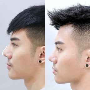 Resultado de rinoplastia antes y después en Somchai Clinic, mejora de la forma nasal masculina