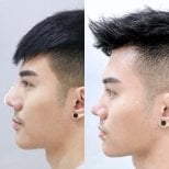 Resultado de rinoplastia antes y después en Somchai Clinic, mejora de la forma nasal masculina