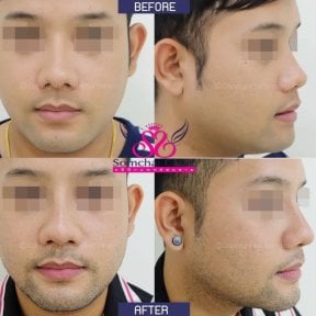 Before and after rhinoplasty results at Somchai Clinic, improved nose shape and profile