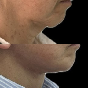 Before and after neck lift results – improved jawline and reduced sagging skin