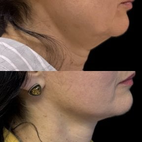 Resultados de lifting de cuello antes y después: mandíbula y contorno más definidos