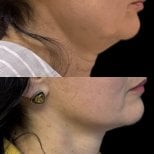 Resultados de lifting de cuello antes y después: mandíbula y contorno más definidos