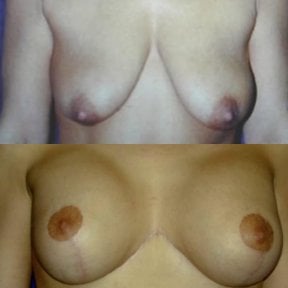 before-after photo breast-augmentation