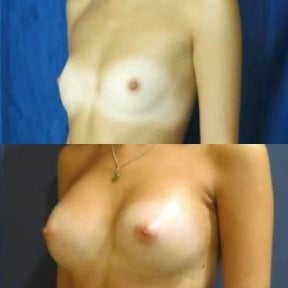 before-after photo breast-augmentation