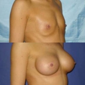 before-after photo breast-augmentation