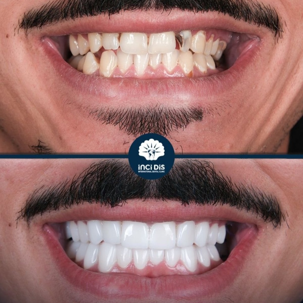 Resultados antes y después de Hollywood Smile en Inci Dis International, transformación con carillas