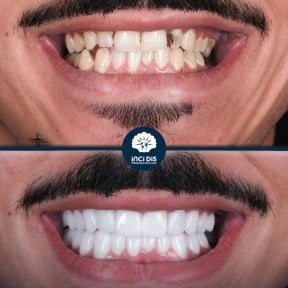 before-after photo hollywood-smile