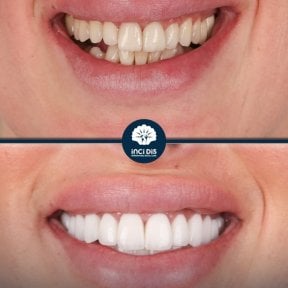 before-after photo hollywood-smile