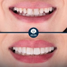before-after photo hollywood-smile