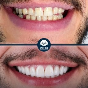 before-after photo hollywood-smile