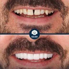 before-after photo hollywood-smile