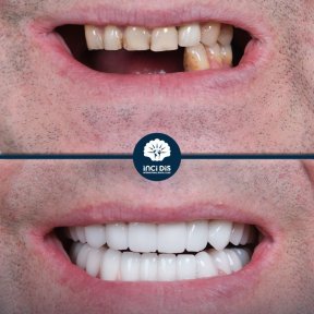 before-after photo dental-implant