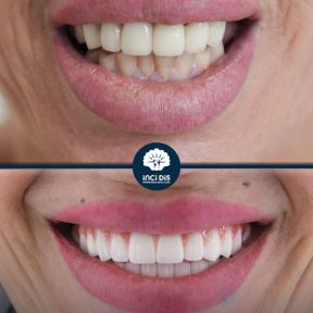 before-after photo dental-implant