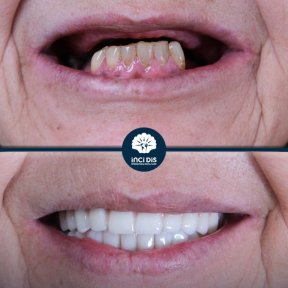 before-after photo dental-implant