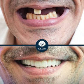 before-after photo dental-implant