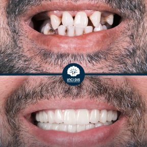 before-after photo dental-implant
