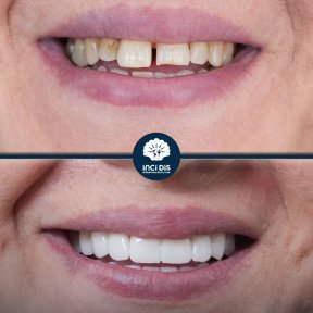 before-after photo zirconia-crown-installation