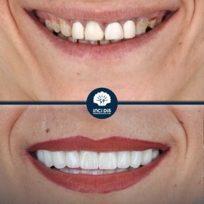 before-after photo zirconia-crown-installation