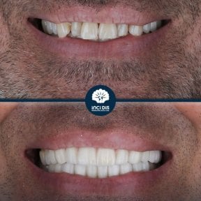 before-after photo zirconia-crown-installation