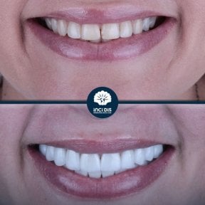 before-after photo zirconia-crown-installation