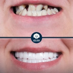 before-after photo zirconia-crown-installation